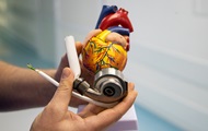 В больнице Киева впервые имплантировали механическое сердце - «Фото»