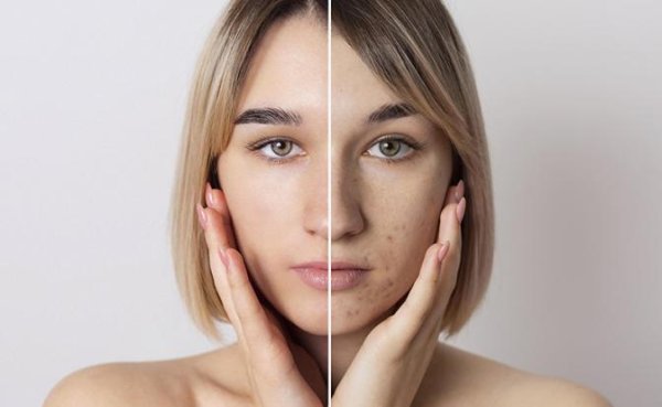 Почему стресс и нарушение сна могут вызывать акне - «Здоровье»